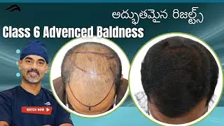 Hair Transplant In Hyderabad | Best Clinic Results & Doctor Of Hair Transplant Surgery In Hyderabad