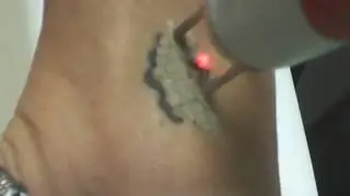 Removing Tattoos with Laser Tattoo Removal Machine West Auckland