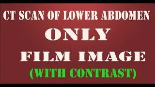 ct scan of lower abdomen film images