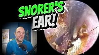 SNORER'S EAR! 371 #ear #earwax #earwaxremoval #earwaxclinic #satisfying #foryou #fyp #foryourpage