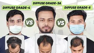 Hair Transplant in Tirupati | Best Results & Cost of Hair Transplant in Tirupati