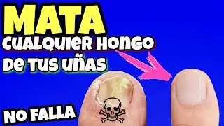 ESTO es CIEN veces más Efectivo Que otros Remedios CASEROS para MATAR los Hongos en las Uñas
