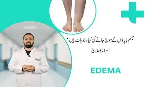 What Is Edema? - Causes and Treatment | tibbi