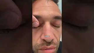 7 Days Post Upper Blepharoplasty &mdash; In-Office Procedure ✨