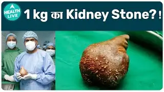 The Largest Kidney Stone In The World?! | Health Live