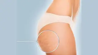 Celulitis &iquest;Qu&eacute; tipos hay?