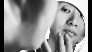 Acne Scar Treatment (Singapore) CAN Be 100% Effective