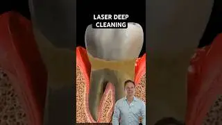 Laser deep cleaning for gum disease (periodontal disease) #dentalhygiene #dentist
