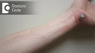 Causes & management of reoccuring open wounds with history of Cellulitis - Dr. Pradeep Kumar T J