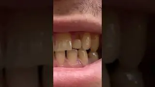 В 31 год молочный зуб 🦷 #молочныезубы