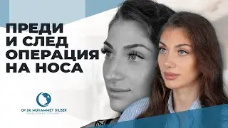 Операция на носа на братя близнаци