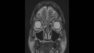 Sinus headaches
