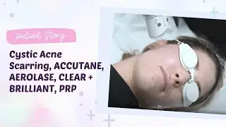 Patient Story: Cystic Acne Scarring, ACCUTANE, AEROLASE, CLEAR + BRILLIANT, PRP | Dr. Jason Emer