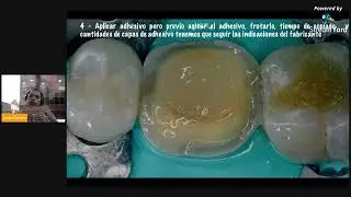 CEMENTACION CON RESINA PRECALENTADA Dr Jorge Chávez