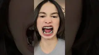 Full of Metal !(These are not Hydraulic Suspension)🤣 #foryou #braces #herbst  #herbstappliance #tads