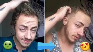 My Hair Loss On T Insecurities (FTM)