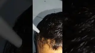 After applying #minoxidil. condition