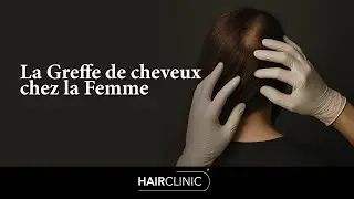 Greffe de cheveux sans rasage pour femme : La solution discr&egrave;te contre la perte de cheveux