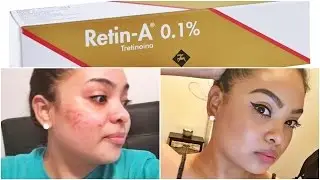 HOW TO GET CLEAR SKIN! Get Rid of ACNE + DARK SPOTS Using RETIN-A Cream