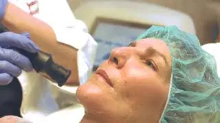 Center for Classic Beauty: ThermiSmooth Treatment
