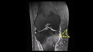 Knee MRI: Tibial Insufficiency Fracture