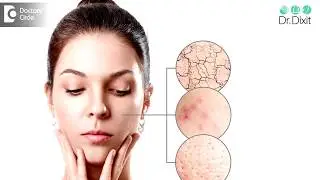 Is oily skin genetic? Is it more prone to acne? - Dr. Rasya Dixit | Doctors' Circle
