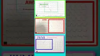 Two Main Type Heart attack ECG 💔🫀 l हार्ट अटैक ईसीजी #ecg #echo #shorts