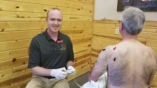 Dry Needling on Shoulder