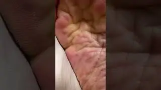 Wrinkled Soles and Arches