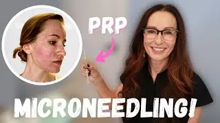 VAMPIRE FACIAL Performed by Transylvanian Doctor! Microneedling with PRP Before & After!