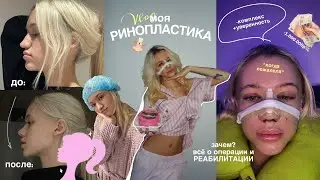 МОЯ РИНОПЛАСТИКА | всё о операции | результат и РЕАБИЛИТАЦИЯ 