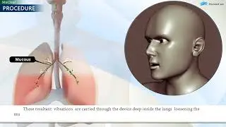 Muclear ( Airway Mucous Clearance Device)