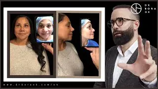 Nose Contouring Surgery by Dr. Bora Ok, Turkey - Ethnic Rhinoplasty