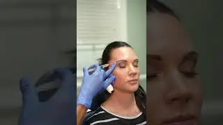 Sculptra Treatment #sculptra #fillertreatment  #collagenstimulation