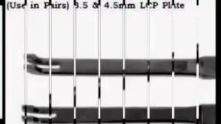 4803.120 Instruments For Locking Plates Large Fragment