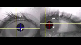 NYSTAGMUS DURING POSITIONAL TEST FOR LATERAL CANAL LEFT