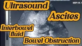 Ultrasound Bowel Obstruction | Dilated Bowel Loops | Peristalsis Absent | Intestinal obstruction