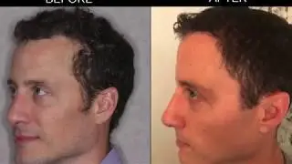 NeoGraft Advanced Hair Restoration: Gentle, Superior Results, and Quick Recovery!