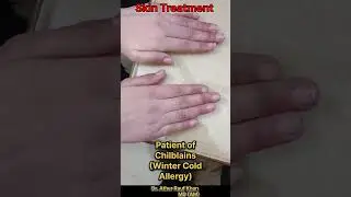 Patient of Chilblains(Winter Cold Allergy) #doctoradvice #skin #trending #winter@DrAtherRaufKhan