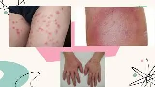 Pulex Irritans y Echidnophaga Gallin&aacute;cea