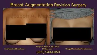 Breast Implant Revision SF Bay Area (Breast Augmentation Revision)