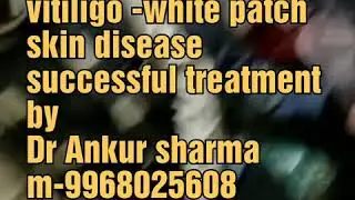 vitiligo- white patch skin disease successful treatment by  Dr ankur sharma