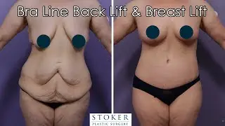 Breast Lift Los Angeles: Top Plastic Surgeon Prepares for a Bra Line Back Lift and Breast Lift