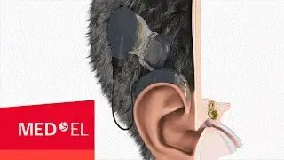 The MAESTRO Cochlear Implant System from MED-EL with OPUS2 XS | 3D | INT