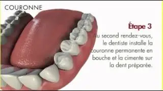 Pont fixe et couronne