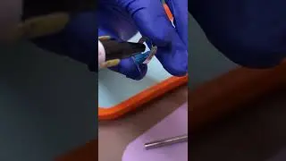Loose Molar Band - Molar Bands Pain - Tooth Time Family Dentistry New Braunfels Texas