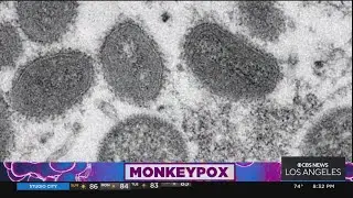 Know the facts about Monkeypox and the vaccine to fight it