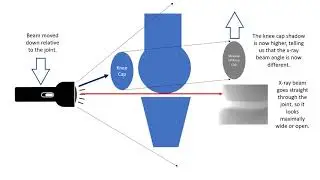 Knee Arthritis X rays after Stem Cell Therapy