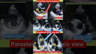 Normal Echo view for beginners l नॉर्मल एको #echo #shorts