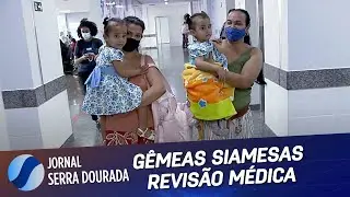 JSD - Gêmeas siamesas separadas passam por revisão médica em Goiânia